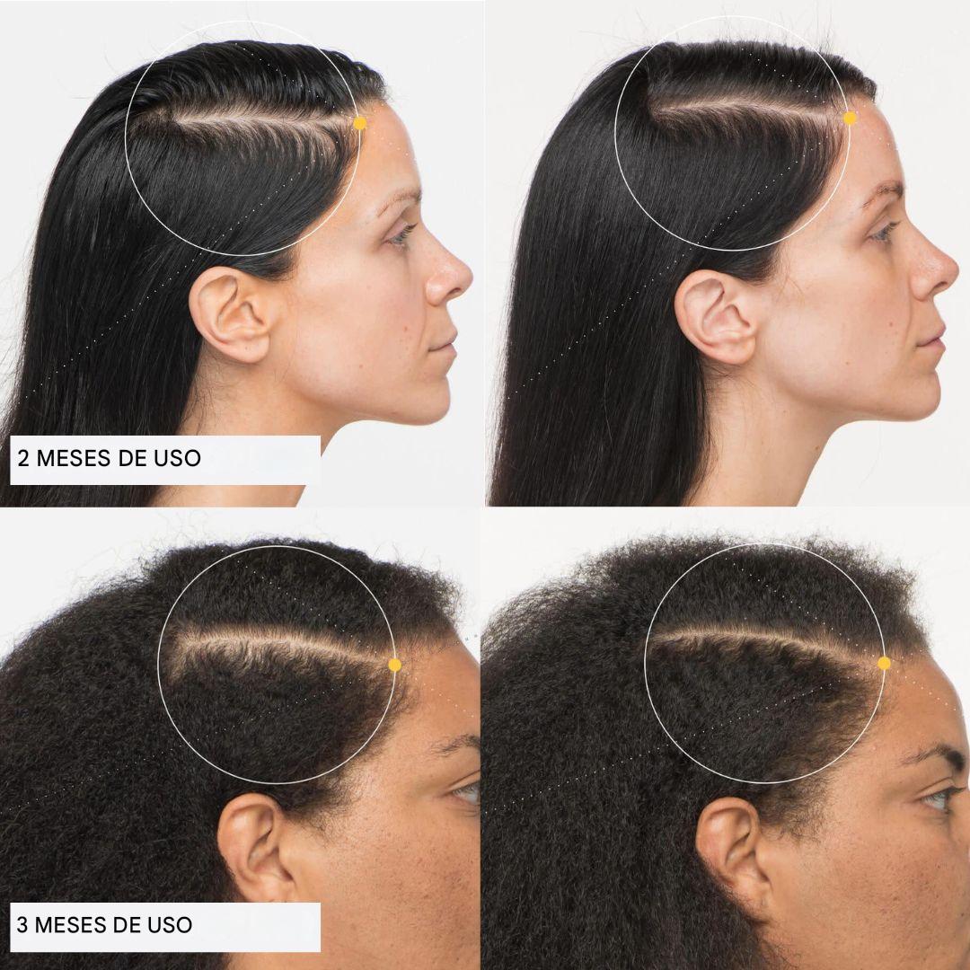 Recupera el cabello voluminoso y fuerte de tus 25 con BATANIX
