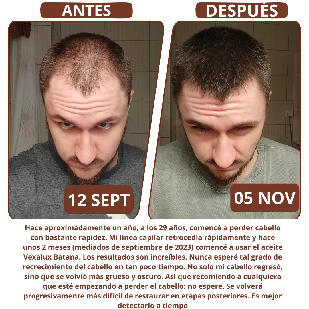 Recupera el cabello voluminoso y fuerte de tus 25 con BATANIX